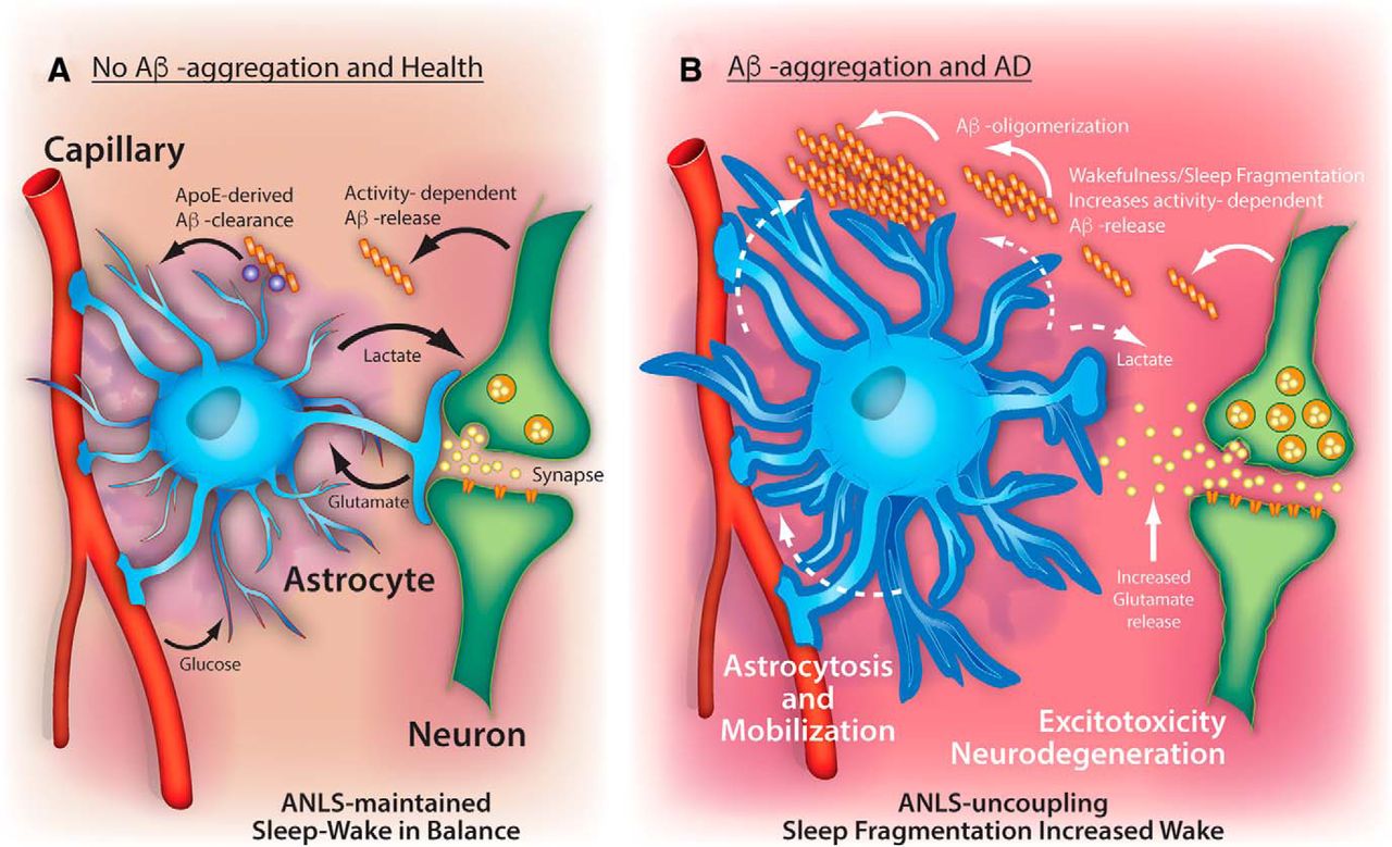 مشکلات خواب و بیماری آلزایمر
