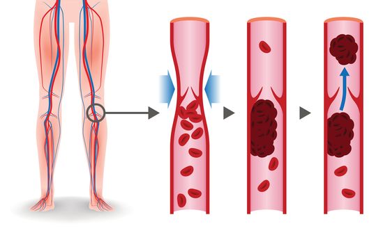 Deep Vain Thrombosis