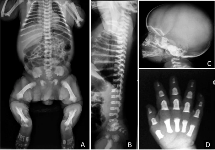 آکندروپلازی xray