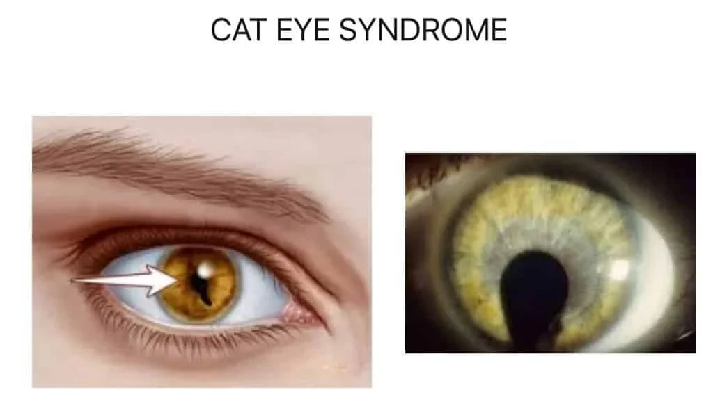 علائم و نشانههای سندرم چشم گربه ای