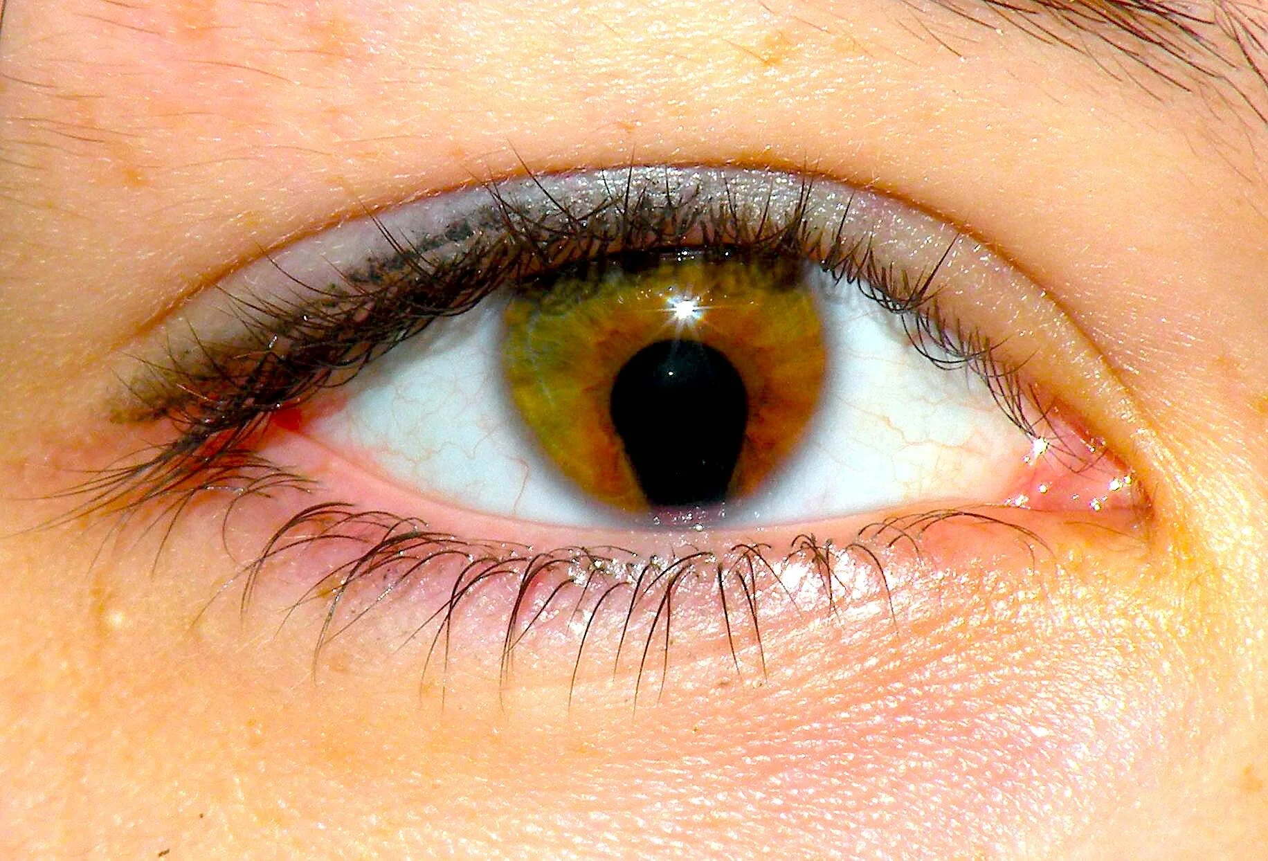 سندرم چشم گربه ای چیست؟