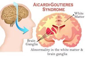 سندرم Aicardi-Goutieres  (آیکاردی گوتیرز) 