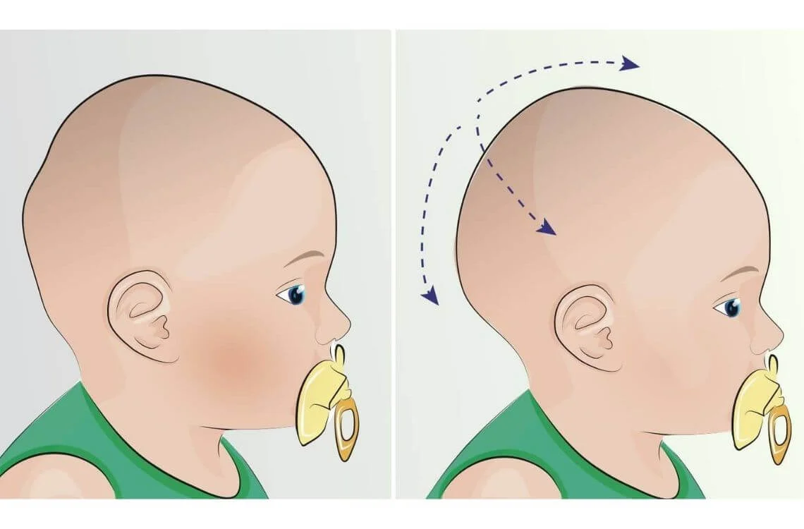 سر شخص مبتلا به سندرم کری دو چت