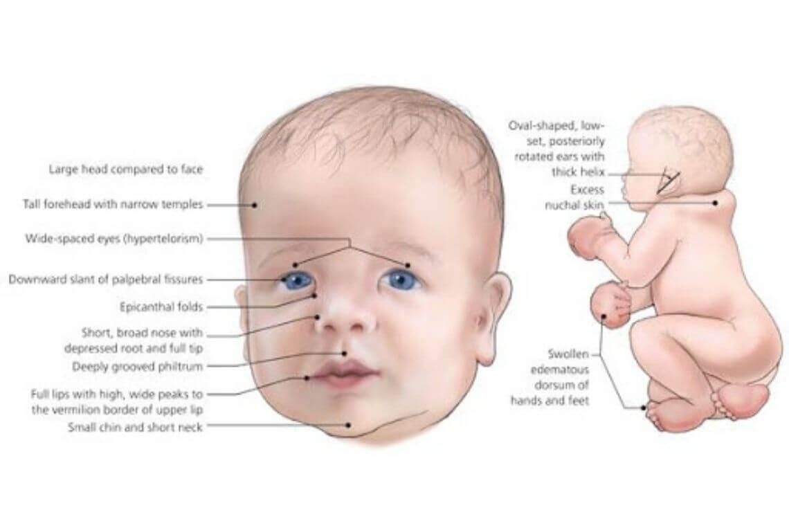 علائم و نشانههای سندرم فریاد گربه