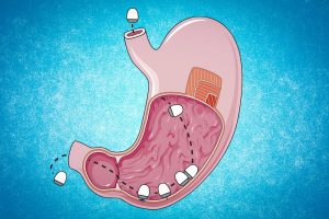 قرص RNA معده