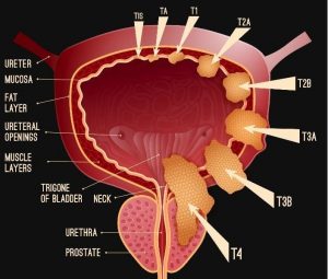 سرطان مثانه (Bladder Cancer) چیست؟