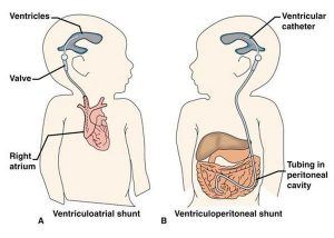 تومورهای مغز و نخاع