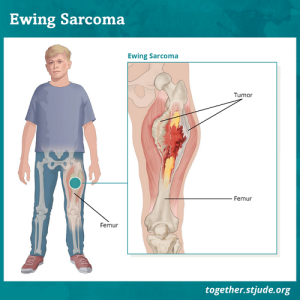 سرطان استخوان (Bone Cancer)