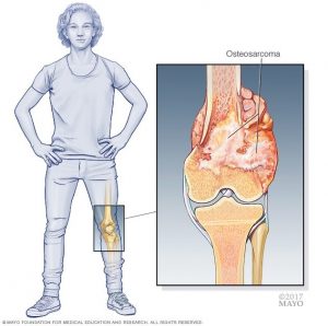 سرطان استخوان (Bone Cancer)
