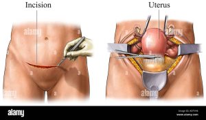 سرطان آندومتر (Endometrial Cancer)