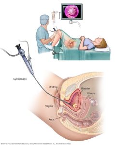 سرطان آندومتر (Endometrial Cancer)