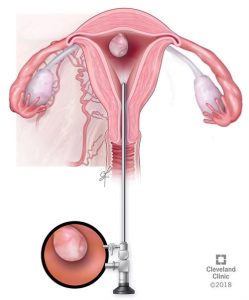 سرطان آندومتر (Endometrial Cancer)