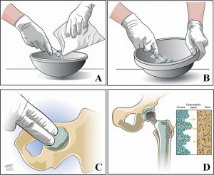 سرطان استخوان (Bone Cancer)
