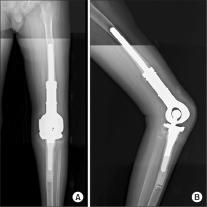 سرطان استخوان (Bone Cancer)