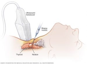 سرطان استخوان (Bone Cancer)