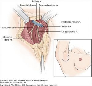 سرطان سینه در مردان