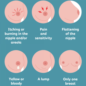 سرطان سینه در مردان