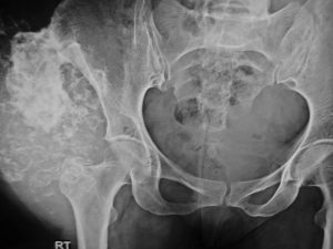 سرطان استخوان (Bone Cancer)