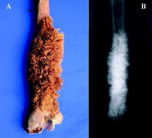 سرطان استخوان (Bone Cancer)