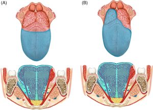 سرطان ‌حفره دهانی