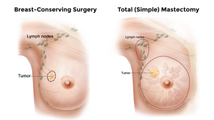 درجه سرطان سینه (Breast Cancer Grade)