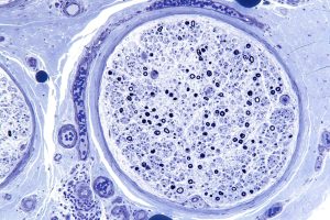 سرطان ‌حفره دهانی