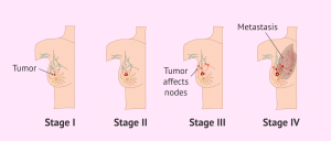 درجه سرطان سینه (Breast Cancer Grade)