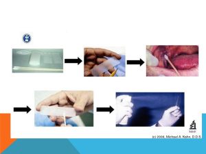 سرطان ‌حفره دهانی