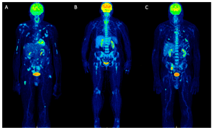سرطان ‌حفره دهانی