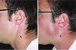 سرطان غدد بزاقی (Salivary Gland Cancer) چیست؟