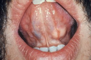 سرطان غدد بزاقی (Salivary Gland Cancer) چیست؟