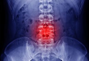 ژن درمانی روشی که آسیب‌های نخاعی را بدون عوارض جانبی با موفقیت درمان می‌کند.