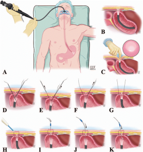 سرطان غدد بزاقی (Salivary Gland Cancer) چیست؟