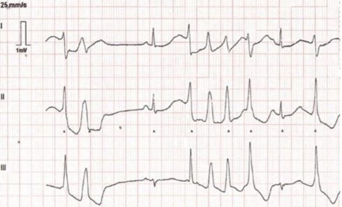 CBD (فیتوکانانابینوئید موجود در گیاه شاهدانه)، ممکن است آنطور که فکر می‌کنید، ایمن نباشد.