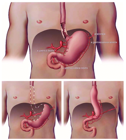 درمان سرطان مری
