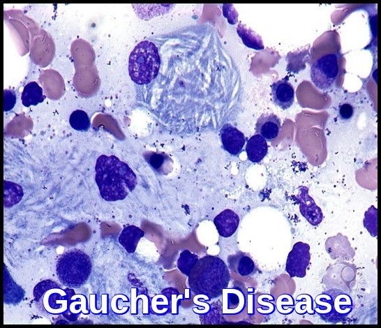 بیماری-گوچر-gaucher-disease چیست؟