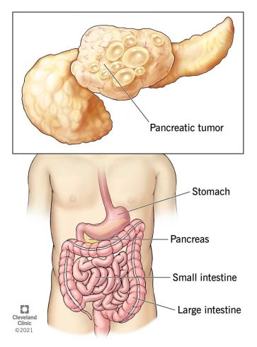 سرطان پانکراس (Pancreatic Cancer) چیست؟