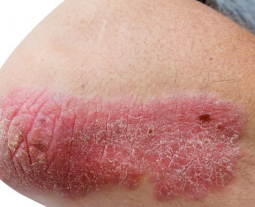 علائم پسوریازیس