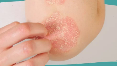 علل پسوریازیس