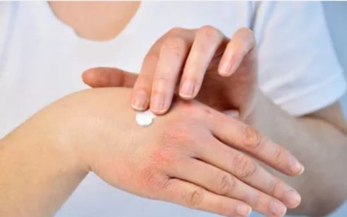 درمان پسوریازیس با کرم