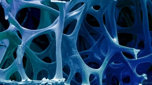 فشار خون بالا و پوکی استخوان