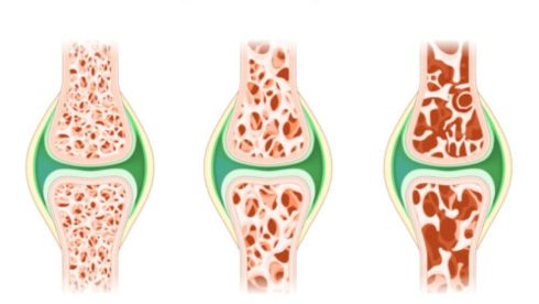 فشار خون بالا و پوکی استخوان