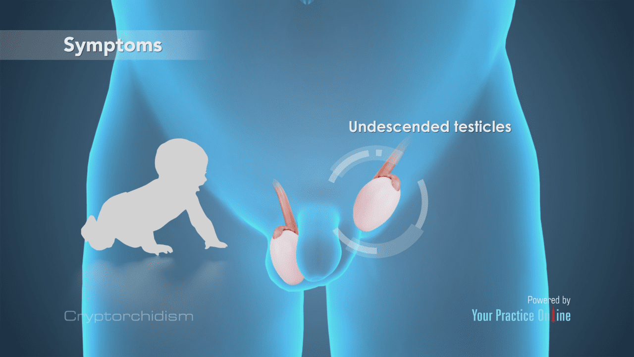 بیضه نزول نکرده