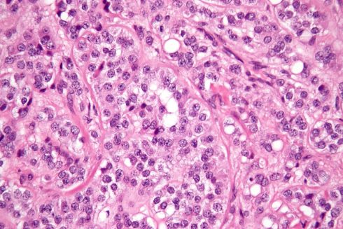 تومورهای سلول سرتولی (Sertoli cell tumors)
