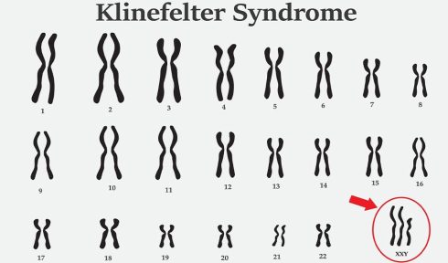 سندرم کلاین فلتر (Klinefelter's syndrome)