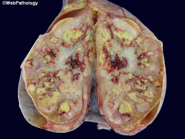 غیر سمینوما (Non-seminomas)
