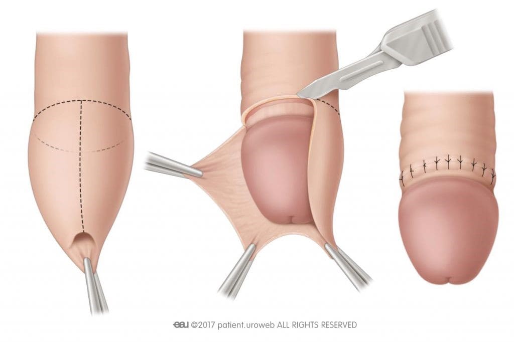 ختنه (Circumcision)