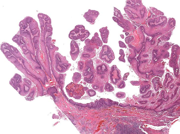 کارسینوم وروکوز (Verrucous carcinoma)