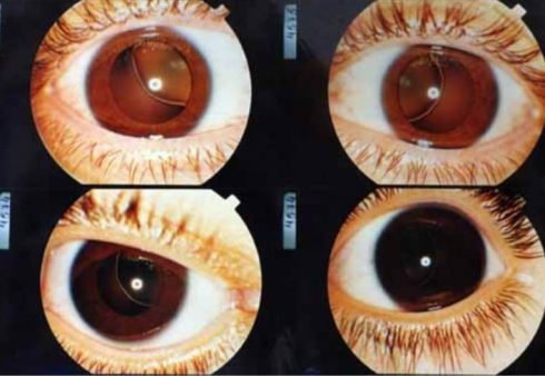 عوارض سندروم مارفان: مشکلات چشمی