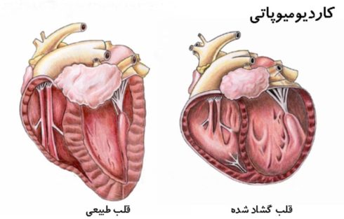 عوارض سندروم مارفان: قلب بزرگ شده